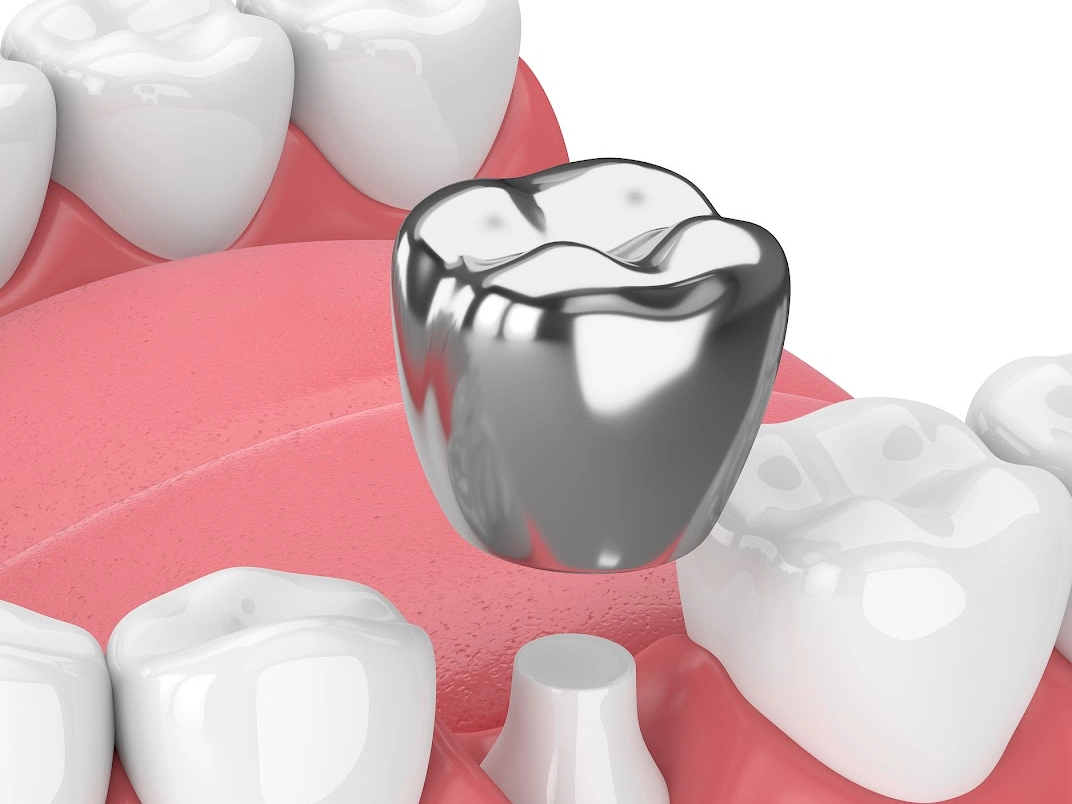 Bọc mão răng inox giúp bảo vệ thân răng tổn thương